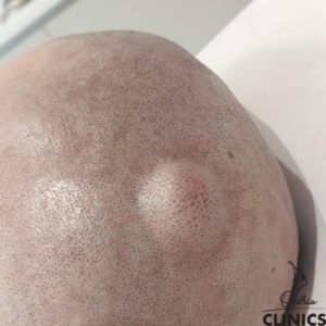 chist sebaceu pe scalp