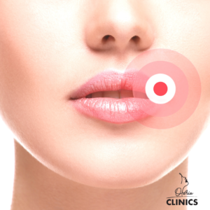 tratament herpes