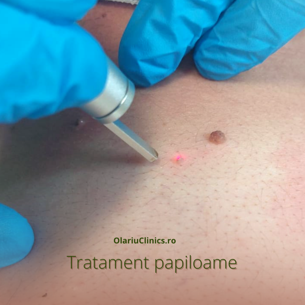 tratament papiloame