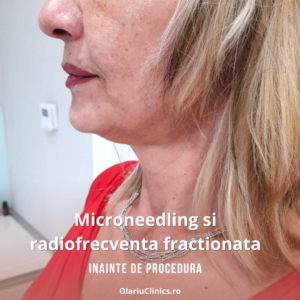 microneedling