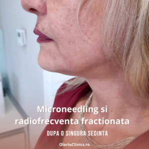 radiofrecventa fractionata