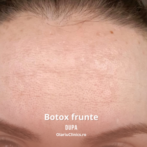 botox frunte