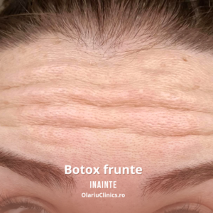 Botox - pentru ridurile de expresie