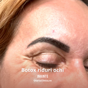 botox riduri