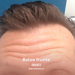 botox riduri