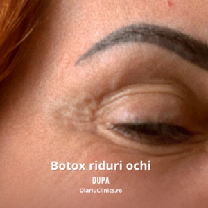 botox riduri ochi