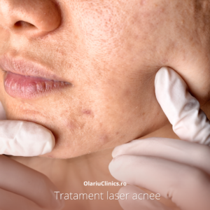 tratament laser acnee