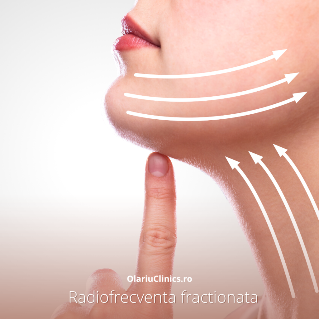 radiofrecventa fractionata