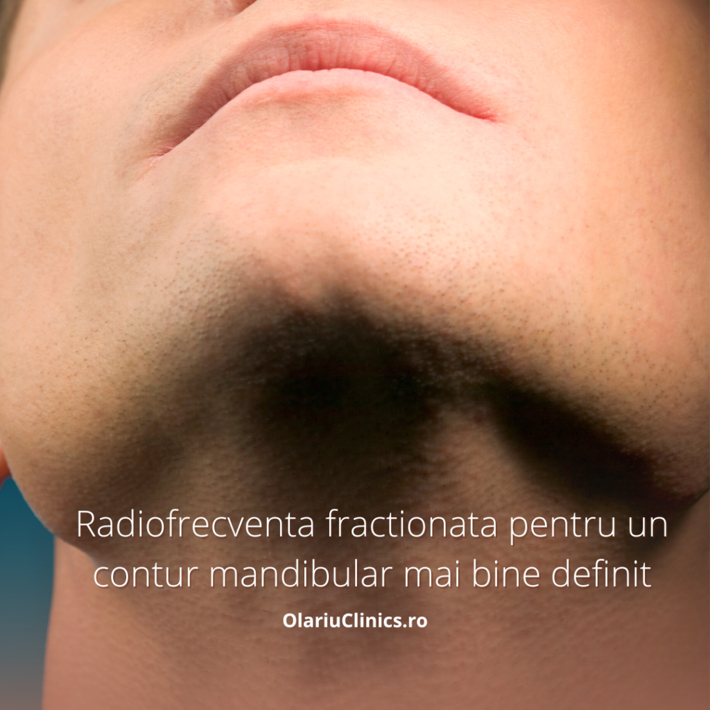 Tonifierea zonei mandibulare cu radiofrecventa fractionata conturare barbie