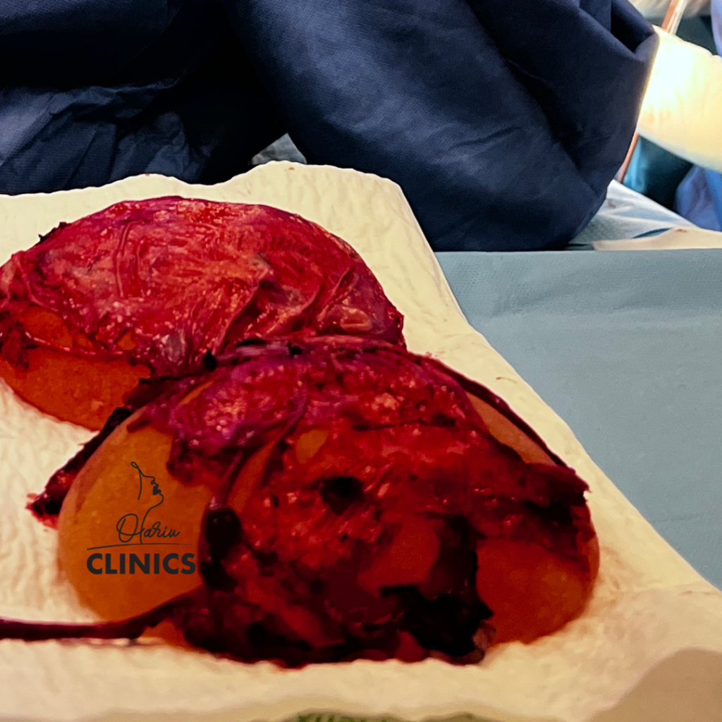 contractura capsulara