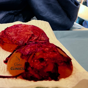 contractura capsulara