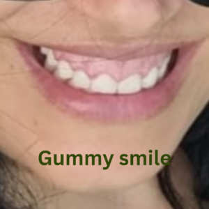 gummy smile