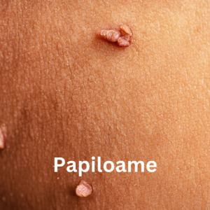 papiloame genitale