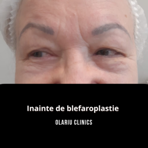 blefaroplastie chirurghicala