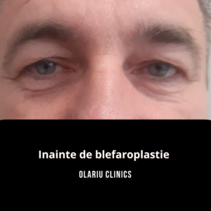 inainte de blefaroplastie