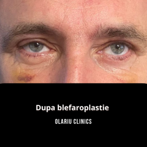 blefaroplastie poze