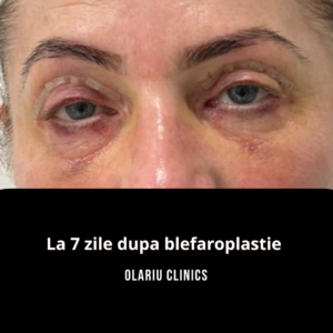 blefaroplastie superioara