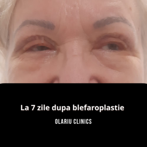 dupa blefaroplastie