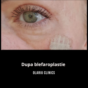 blefaroplastie poze