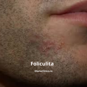 foliculita