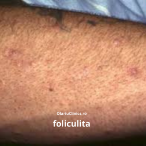foliculita tratament