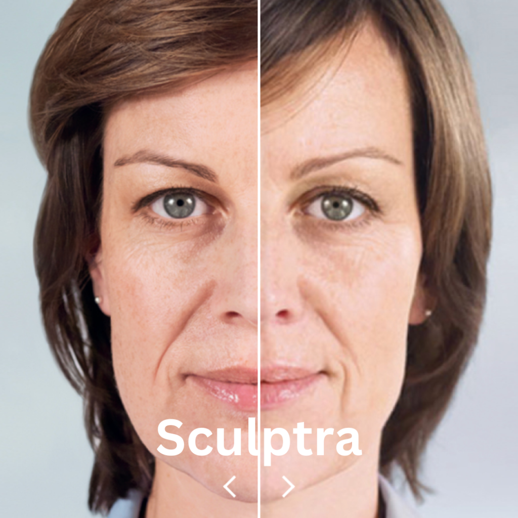 Sculptra - un aliat puternic impotriva imbatranirii sculptra