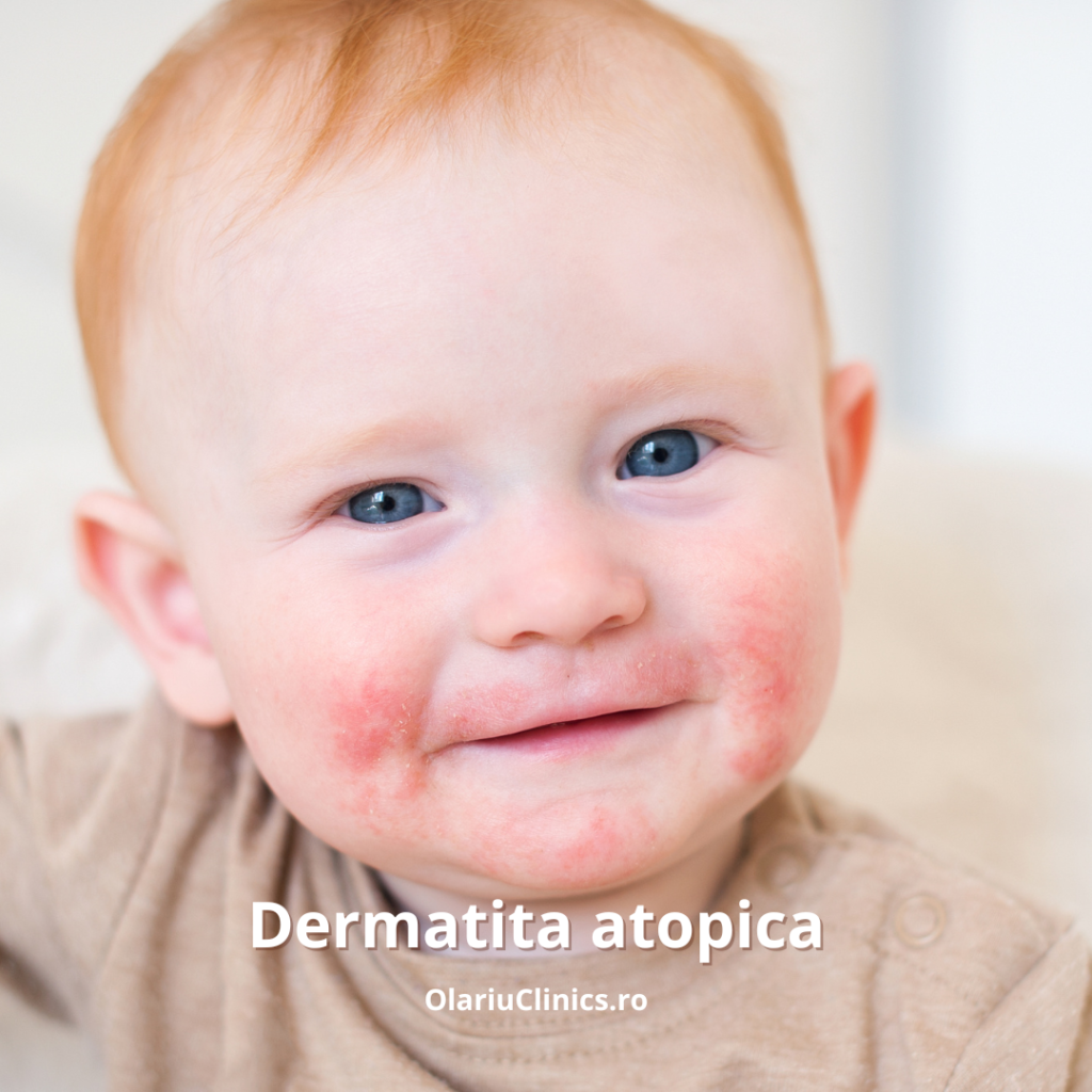 dermatita atopica