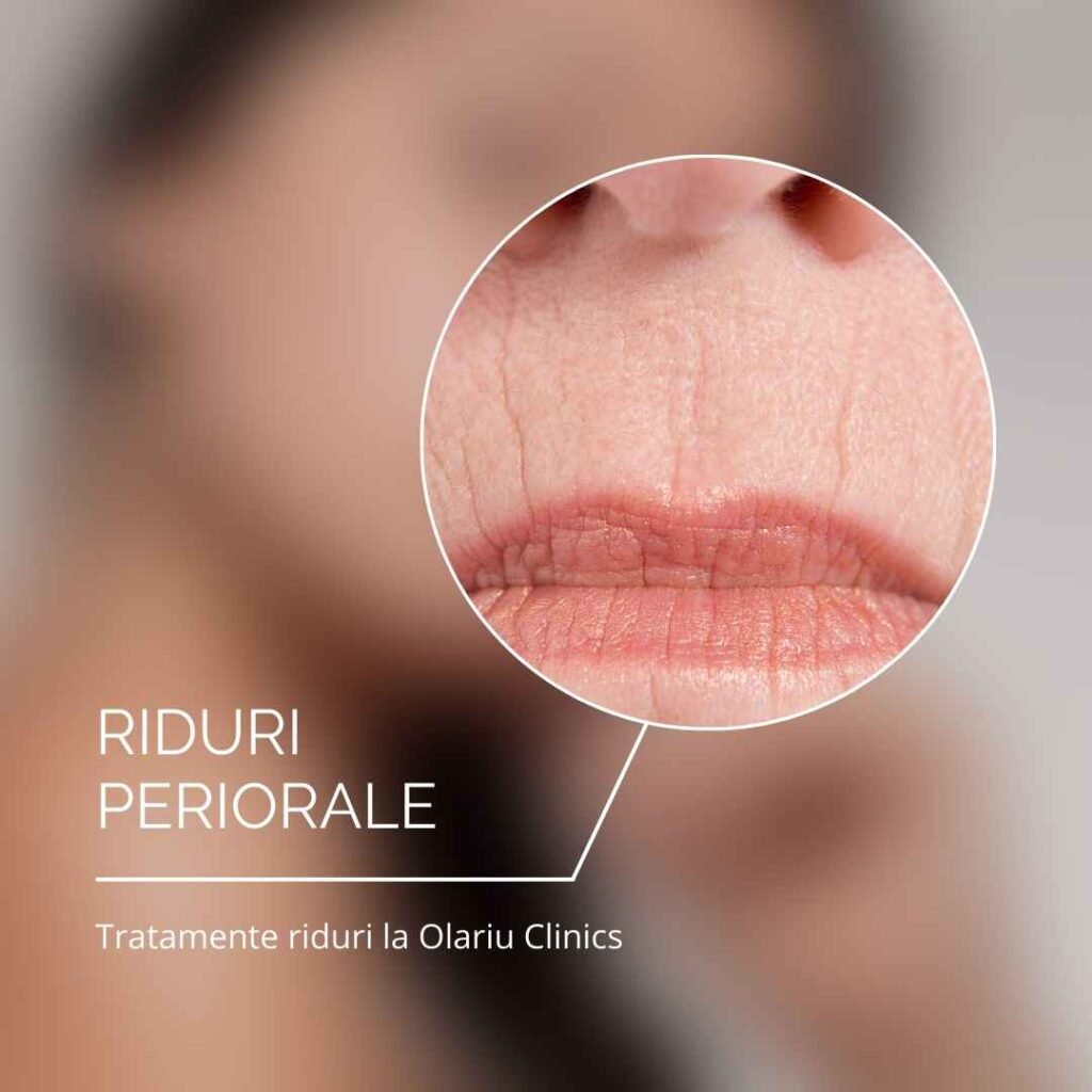 Ridurile din jurul gurii - riduri periorale tratament riduri periorale