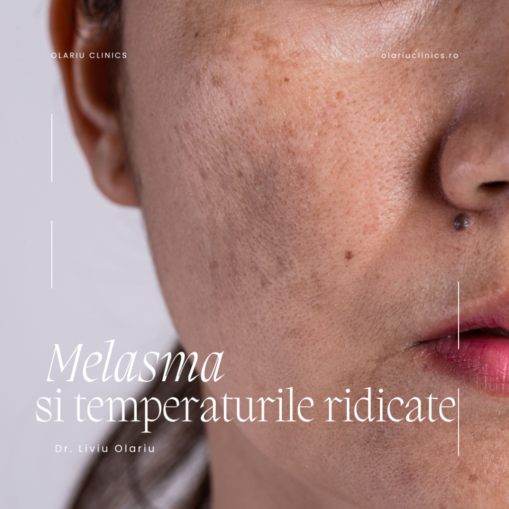 melasma