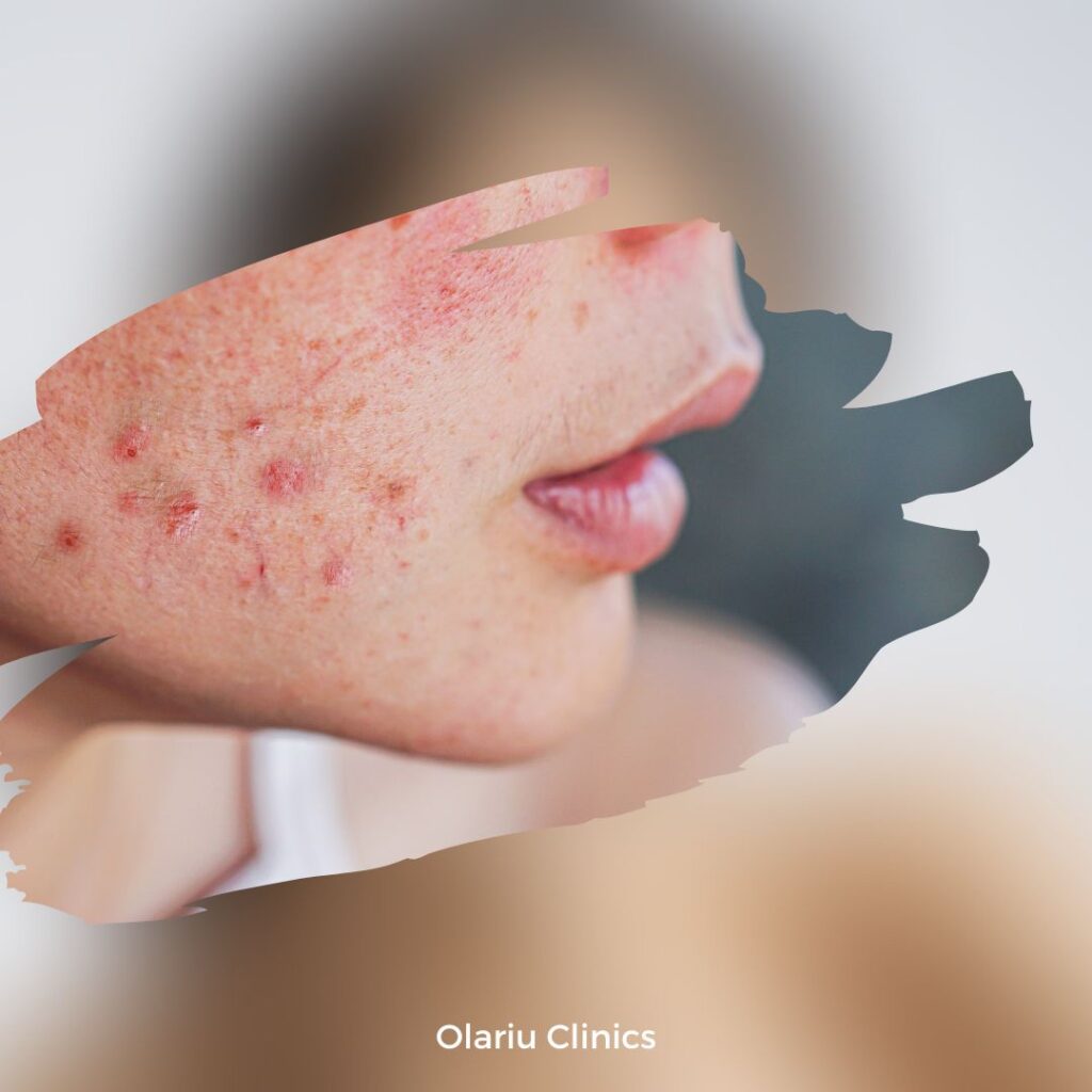 Cum tratam acneea si cicatricile post-acneice tratarea acneei